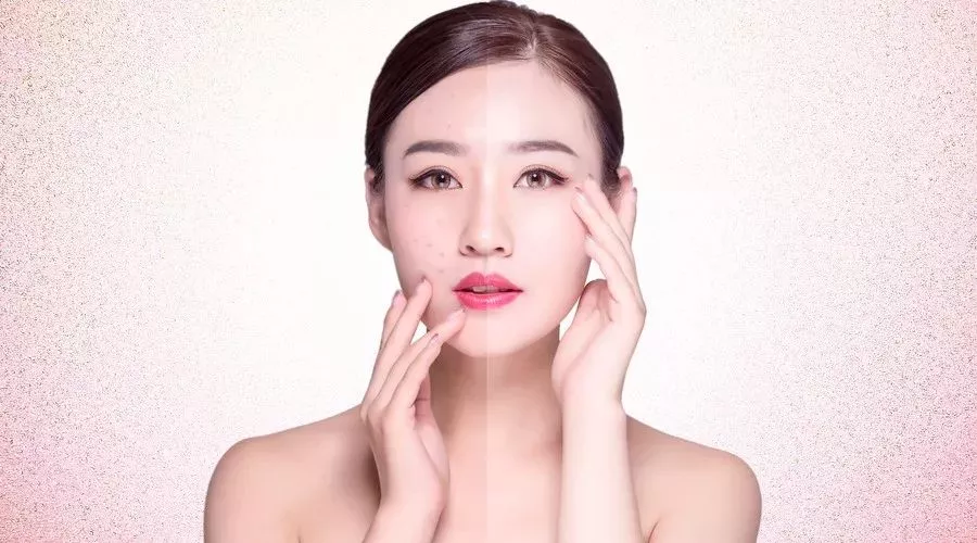 重庆独生美化妆品公司：全城招募免费祛斑 独生美祛斑祛痘 独生美官网