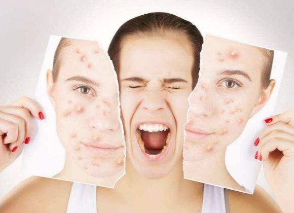 什么是激素脸？你的脸有中激素的毒吗？ 美容护肤独生美官网