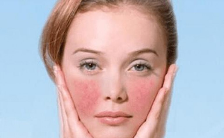 激素脸和过敏脸区别在哪儿？激素脸有哪些症状？激素脸怎么治疗修复好得快？美容护肤独生美官网
